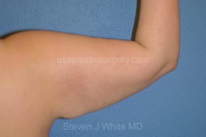 Liposuction - Arms Before & After Patient #5576