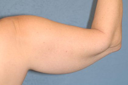 Liposuction - Arms Before & After Patient #5577