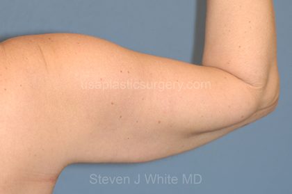 Liposuction - Arms Before & After Patient #5577