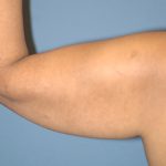 Liposuction - Arms Before & After Patient #5578