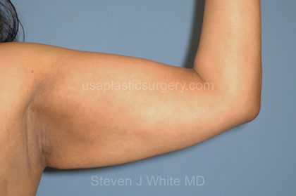 Liposuction - Arms Before & After Patient #5578