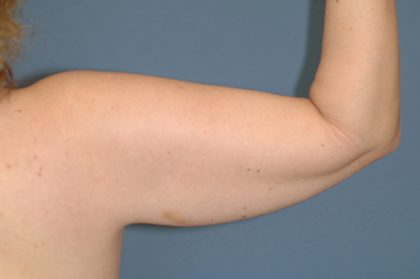 Liposuction - Arms Before & After Patient #5589