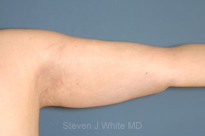 Liposuction - Arms Before & After Patient #5589