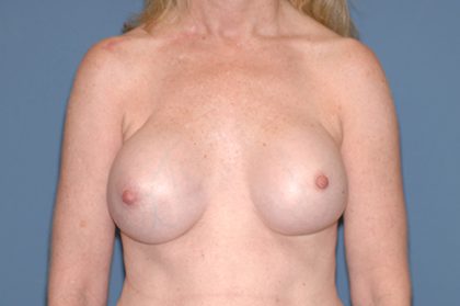 Breast Implants - Revision - Removal & Replacement Before & After Patient #5763