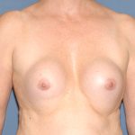 Breast Implants - Revision - Removal & Replacement Before & After Patient #5748