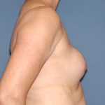 Breast Implants - Revision - Removal & Replacement Before & After Patient #5748