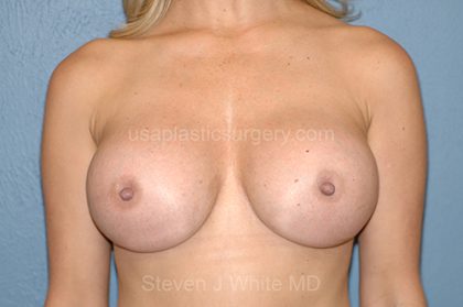 Breast Implants - Revision - Removal & Replacement Before & After Patient #5750