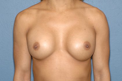 Breast Implants - Revision - Removal & Replacement Before & After Patient #5757