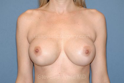 Breast Implants - Revision - Removal & Replacement Before & After Patient #5755
