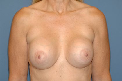 Breast Implants - Revision - Removal & Replacement Before & After Patient #5752