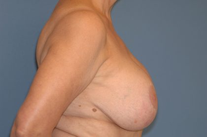 Removal Implants Before & After Patient #5254