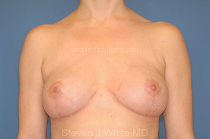 Removal Implants then Breast Lift Before & After Patient #5268