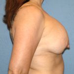 Removal Implants then Breast Lift Before & After Patient #5270