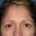 Upper Facelift - Brow Lift Before & After Patient #5900