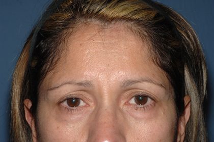 Upper Facelift - Brow Lift Before & After Patient #5900