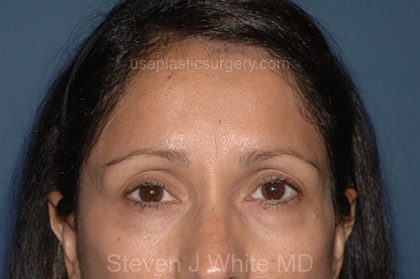 Upper Facelift - Brow Lift Before & After Patient #5900