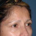 Upper Facelift - Brow Lift Before & After Patient #5900