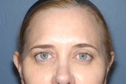 Upper Facelift - Brow Lift Before & After Patient #5901