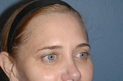 Upper Facelift - Brow Lift Before & After Patient #5901