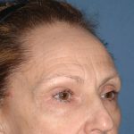 Upper Facelift - Brow Lift Before & After Patient #5907