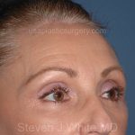 Upper Facelift - Brow Lift Before & After Patient #5907