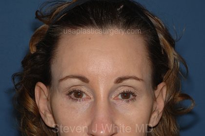 Upper Facelift - Brow Lift Before & After Patient #5909