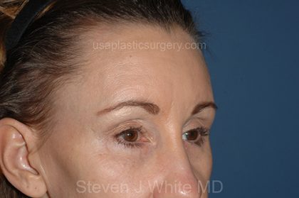 Upper Facelift - Brow Lift Before & After Patient #5909