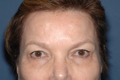 Upper Facelift - Brow Lift Before & After Patient #5902