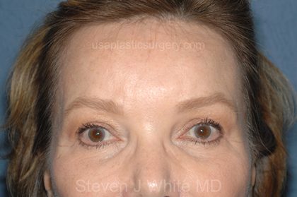 Upper Facelift - Brow Lift Before & After Patient #5902