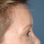 Upper Facelift - Brow Lift Before & After Patient #5902