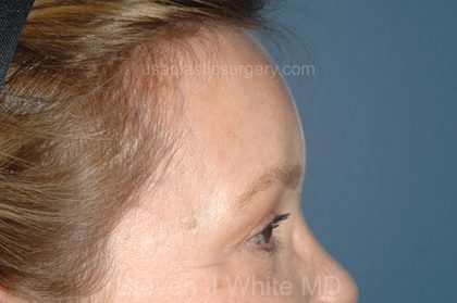 Upper Facelift - Brow Lift Before & After Patient #5902