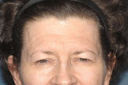 Upper Facelift - Brow Lift Before & After Patient #5903