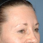 Upper Facelift - Brow Lift Before & After Patient #5903