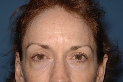 Upper Facelift - Brow Lift Before & After Patient #5906