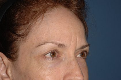 Upper Facelift - Brow Lift Before & After Patient #5906