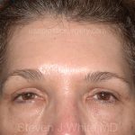 Upper Facelift - Brow Lift Before & After Patient #5908