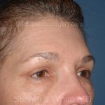 Upper Facelift - Brow Lift Before & After Patient #5908