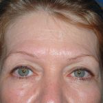 Upper Facelift - Brow Lift Before & After Patient #5904