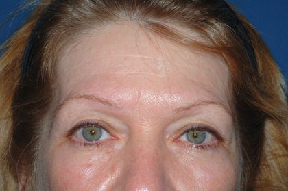 Upper Facelift - Brow Lift Before & After Patient #5904