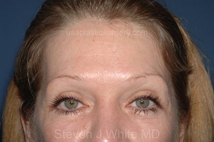 Upper Facelift - Brow Lift Before & After Patient #5904