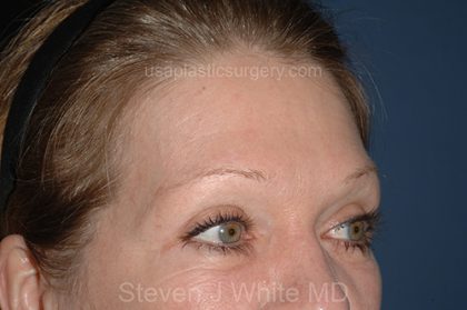 Upper Facelift - Brow Lift Before & After Patient #5904