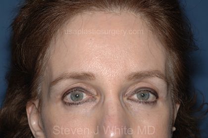 Upper Facelift - Brow Lift Before & After Patient #5905