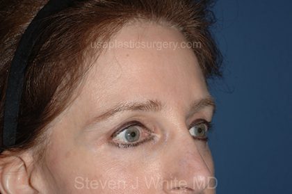 Upper Facelift - Brow Lift Before & After Patient #5905