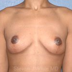 Breast Lift - Mastopexy Before & After Patient #6231