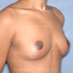 Breast Lift - Mastopexy Before & After Patient #6231