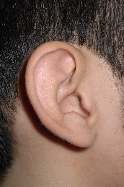 Ear Pinning - Otoplasty Before & After Patient #6119