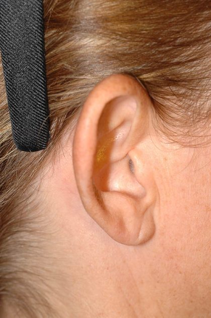 Ear Pinning - Otoplasty Before & After Patient #6120