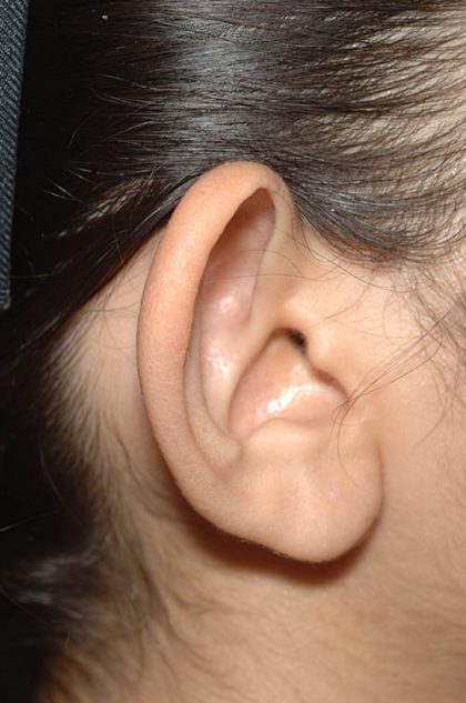 Ear Pinning - Otoplasty Before & After Patient #6118