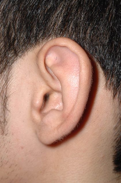 Ear Pinning - Otoplasty Before & After Patient #6119