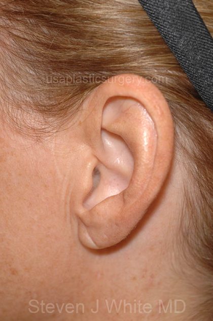Ear Pinning - Otoplasty Before & After Patient #6120